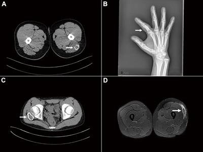 USP6-associated soft tissue tumors with bone metaplasia: Clinicopathologic and genetic analysis and the identification of novel USP6 fusion partners